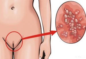 Фото вирус папилломы у женщин на половых органах